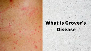 What is Grover's Disease