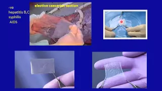 Cornea : 2e Corneal ulcers- non infectious