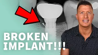 Can dental implants break? - Don’t let this happen to you! • Part 2 of 2