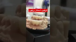 تركيب اسنان زركون قالب اسنان زيركون تثبيت الاسنان