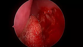 ENDOSCOPIC DCR REVISION HD