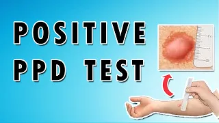 Positive PPD Test - Skin Deep: Understanding the PPD Test for Tuberculosis Diagnosis