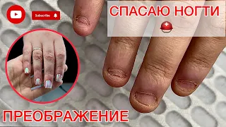 BITCHED MY NAILS 😩 | HOW TO RESTORE SUCH NAILS? #alena_lavrentyeva #nails #podiatrist