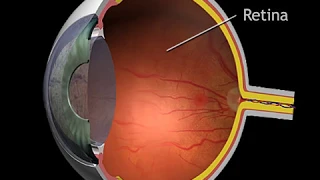 How Diabetes Affects the Eyes Animation - Diabetic Retinopathy Video