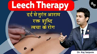 Leech Therapy: दर्द से तुरंत आराम, रक्त शुद्धि और त्वचा के रोगों का रामबाण इलाज | Dr Raj Satpute ||