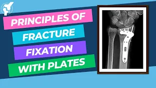 Biomechanics of Fracture Fixation