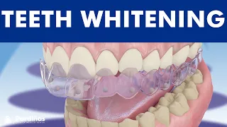 Teeth whitening - How is it done? ©