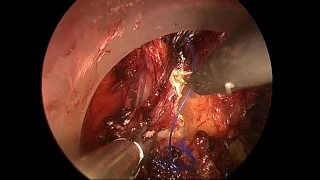 Sequential Laparoscopic TaTME: Successful Removal of 3 cm Rectal Mass