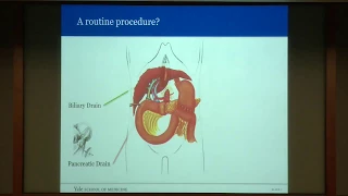 Refining the Whipple Procedure: Yale Contributions