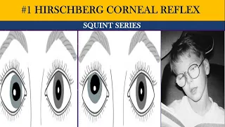Phoria v/s tropia | types of squint | Hirschberg Corneal Reflex Test (HCRT) | Squint series