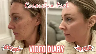 THE COSMELAN PEEL | MY FIRST CHEMICAL PEEL | DIARY FROM APPLICATION TO DAY 30