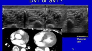 Ultrasound Scanning for Deep Venous Thrombosis