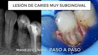 Empaste profundo (caries radicular) debajo de la encía y matar el nervio, todo con aislamiento