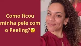 FIZ O TRATAMENTO PARA MANCHAS DE ACNE NO MEU ROSTO | TRATAMENTO A DISTANCIA.