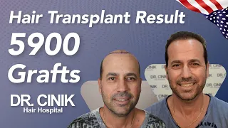 Hair Transplant Result with 5900 Grafts| Before&After | Dr. Emrah Cinik