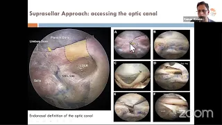 Surgical Anatomy for Endonasal Skull Base Approaches- Kumar Abhinav