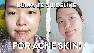 Best skincare for acne skin? Do acne spot treatments really work? Ultimate Guideline for acne skin!