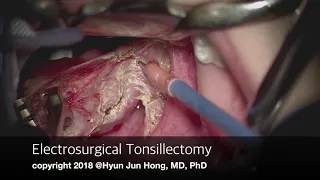 Electrosurgical Tonsillectomy under Surgical Mircoscopy