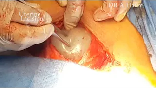 4th Recurrent Caesarean Section Operation