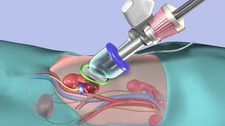 Cleveland Clinic's First in the World to Perform Robotic Single-Port Kidney Transplant