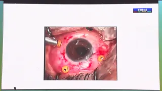 AIOC2020 GP040 T1 Dr  Amit Khosla Video showing management of anterior segment complications in the