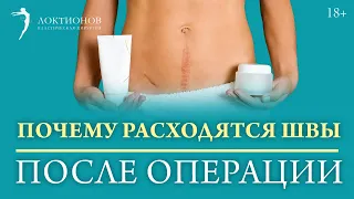 Расхождение швов после операции: причины, симптомы и решение проблемы / 18+