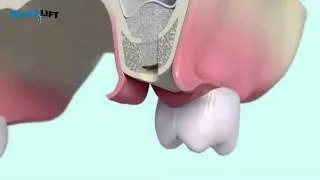 IntraLift® 3D by SATELEC® ACTEON®   YouTube