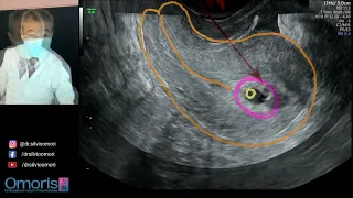 Mom's uterus in early pregnancy - 5 weeks