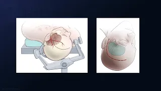 Resection of a Giant Sphenoid Wing Meningioma