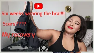 My breast reduction journey | Six weeks recovery | Revealing my scars | South African YouTuber