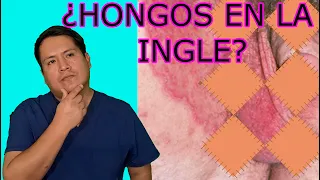 CÓMO ELIMINAR LA TIÑA INGUINAL | HONGOS EN LA INGLE