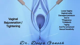 Vagina tightening Animation | Dr.Deepa Ganesh | Cosmetic Gynecologist Chennai.