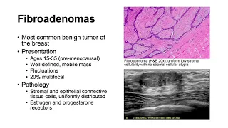 Fibroadenomas and Phyllodes Tumors