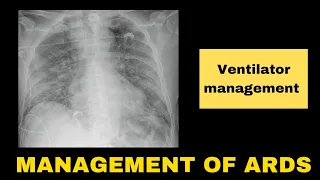 Management of ARDS || Basic Ventilator Management