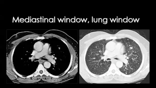 CT chest Prof. Dr. Mamdouh Mahfouz