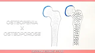 Diferença de Osteopenia e Osteoporose