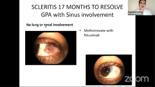 AIOC2021-GP78-Topic-Dr.Amit Khosla-Biologicals in uveitis