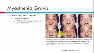 Myasthenia Gravis Clinical Characteristics