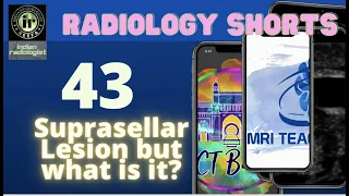 Supra Sellar Tumor but what is it?  21st MRI teaching course  || #radiologyshorts #nobakbak