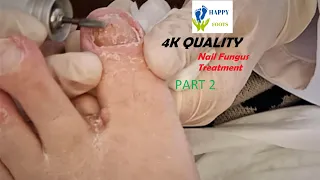 Athlete's foot treatment animation ASMR 속이 뻥 뚫리는! 오래된 무좀 발톱 케어 애니메이션 | 🦶 Happy Foots Callus Podiatry