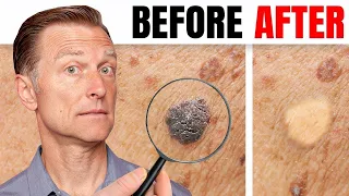 How to Remove Skin Tags and Warts Overnight - Dr. Berg Explains