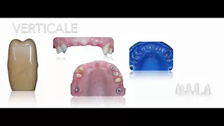 Preparazione Verticale Protesi su Denti Naturali di Fabio Scutellà