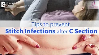 C-Section Stitch Infections:Signs, Prevention & Treatment | Immediate Care-Dr.Shashikala Hande of C9