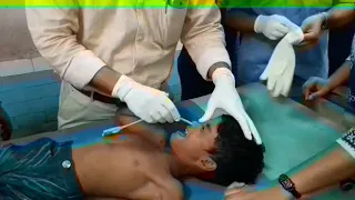 Coin removal from throat