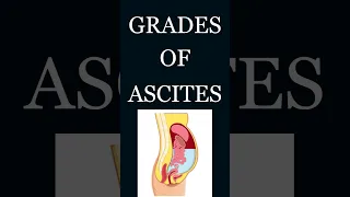 Grades of Ascites