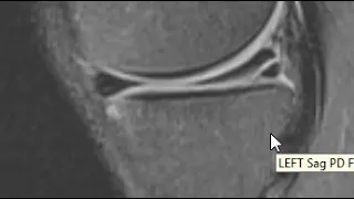 Knee MRI Scan of a Meniscus Tear | First Look MRI