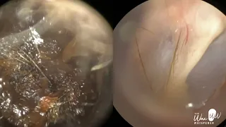 157 - Severe Ear Wax Extraction From Difficult Twisty Ear using the WAXscope®️