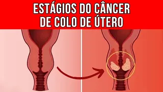 Quais são os estágios do CÂNCER DE COLO DE ÚTERO?