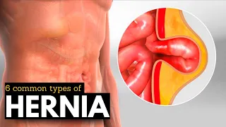 Hernia Breakdown: Discovering the 6 Most Prevalent Types