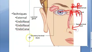 Ophthalmology 405 a DacryoCystoRhinostomy DCR